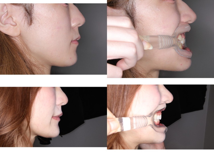 ワイヤー矯正の症例写真