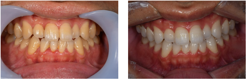 ビフォーアフター画像